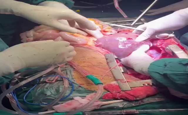 Organ retrieval process